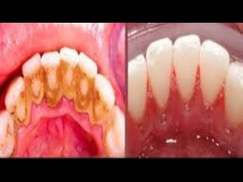 This Not A Joke Remove Dental Plaque In 2 Minutes Without Going To The Dentist