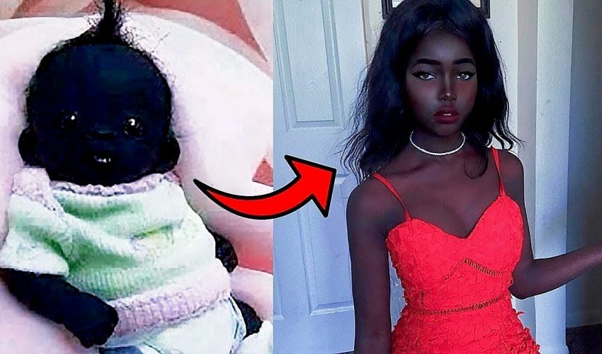 Unusual People Born with The Rarest Skin Color